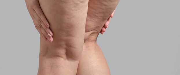 Lipedem: pogosto spregledana bolezen, ki ni debelost