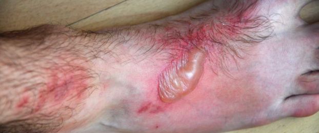 Fototoksični in fotoalergijski dermatitis