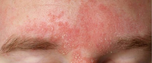 Bolezen kože &ndash; seboroični dermatitis