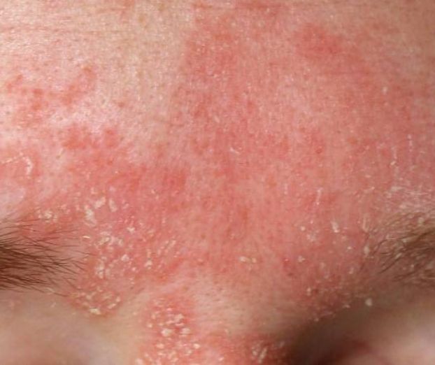 Bolezen kože &ndash; seboroični dermatitis