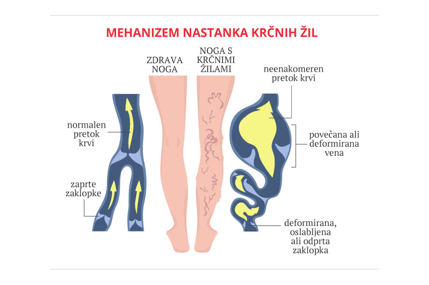 Varicoză noga noga. Operație pentru varice ale extremităților inferioare - Bataturi April