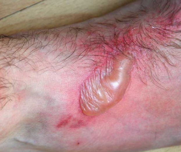 Fototoksični in fotoalergijski dermatitis
