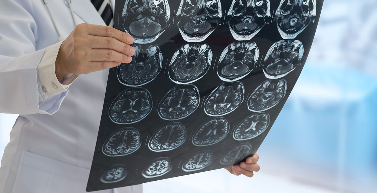 Možganska kap: prepoznajte simptome in takoj ukrepajte