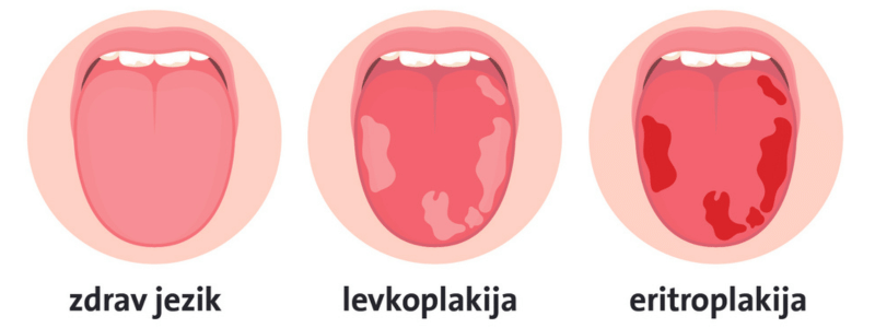 Ilustracija treh jezikov za primerjavo: zdrav jezik svetlo rožnate barve, jezik z levkoplakijo z belkastimi lisami ter jezik z eritroplakijo z rdečimi lisami; pod vsako sliko je ustrezna oznaka.