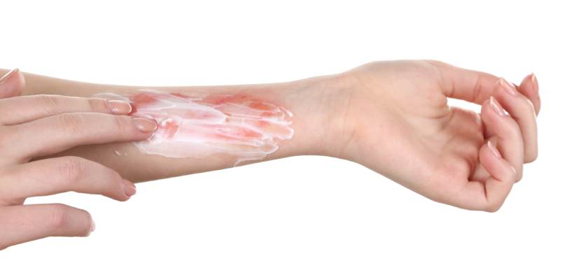 Fotografija roke, na podlahti rdeča opeklina, čez katero je razmazn bel losjon za vlaženje kože.