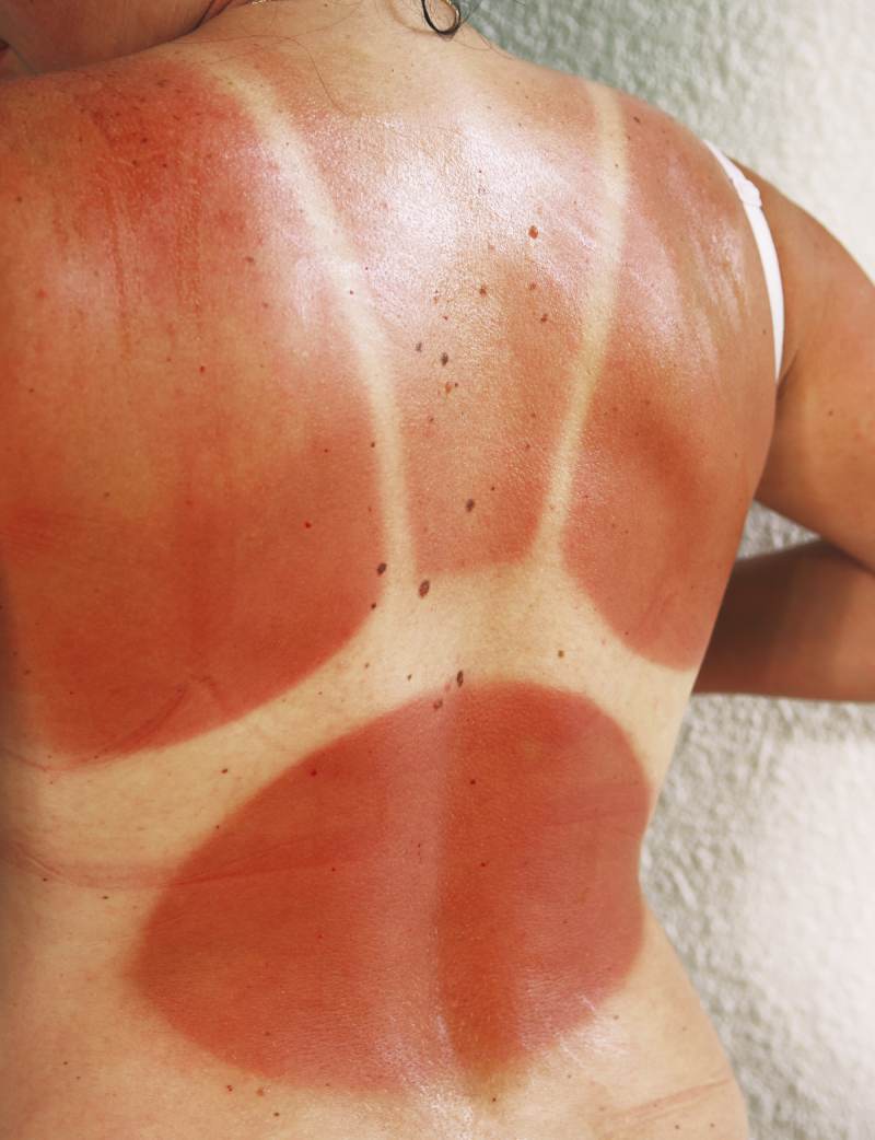 Opečena koža na hrbta in odtis kopalk