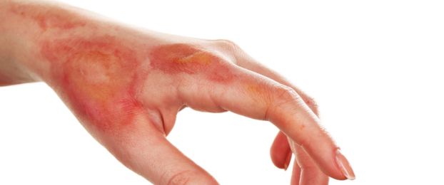 Prva pomoč &ndash; opekline