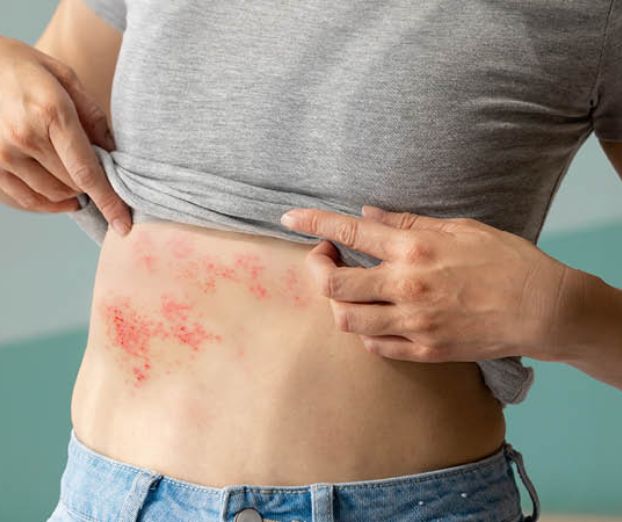 Herpes zoster ‒ pasavec