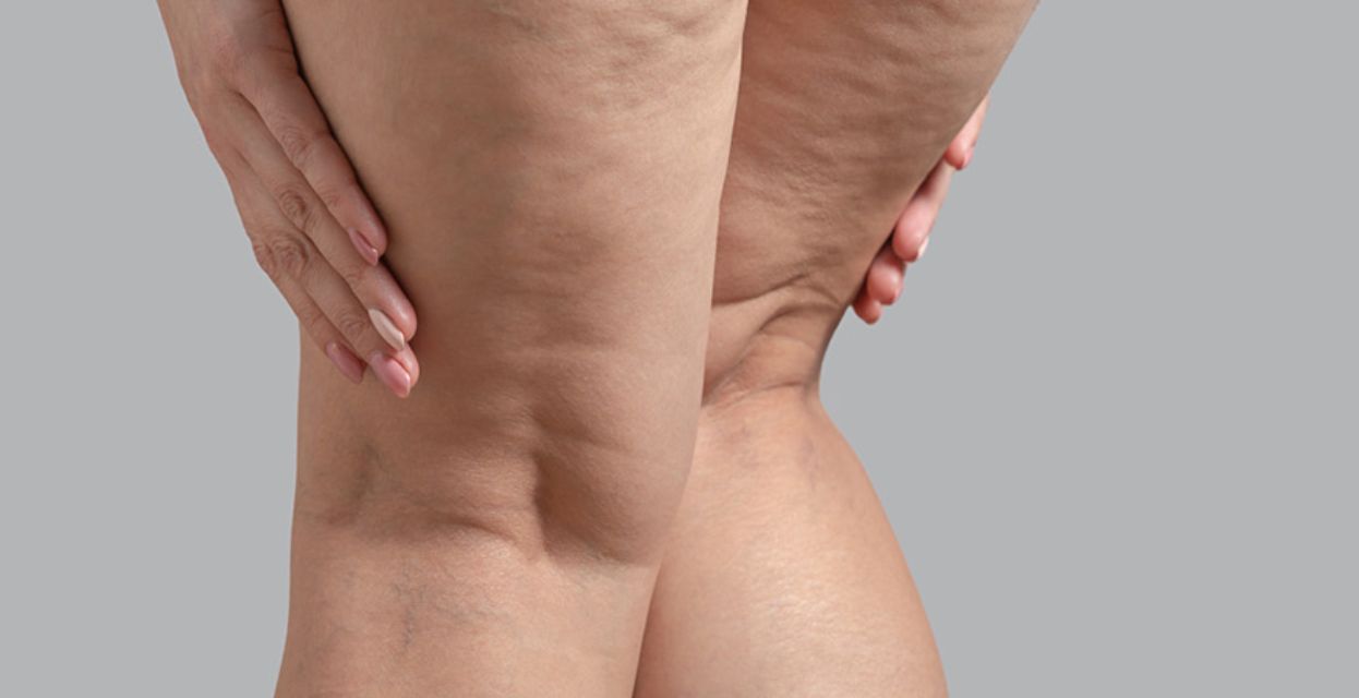 Lipedem: pogosto spregledana bolezen, ki ni debelost