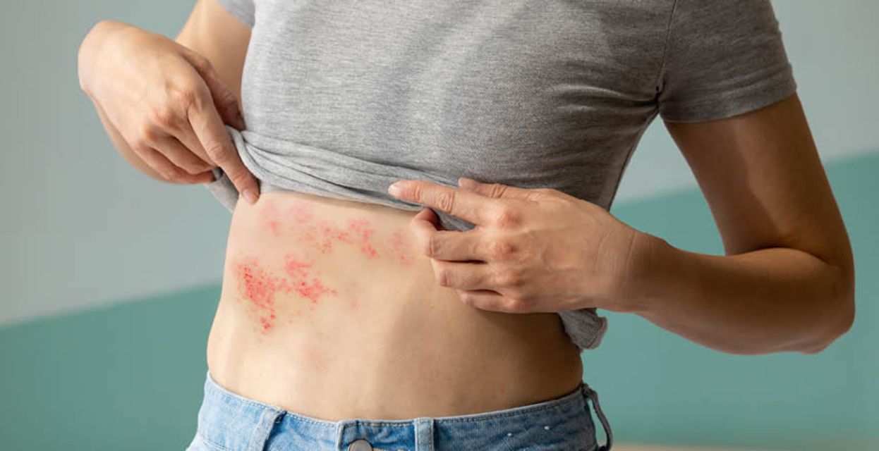 Herpes zoster ‒ pasavec