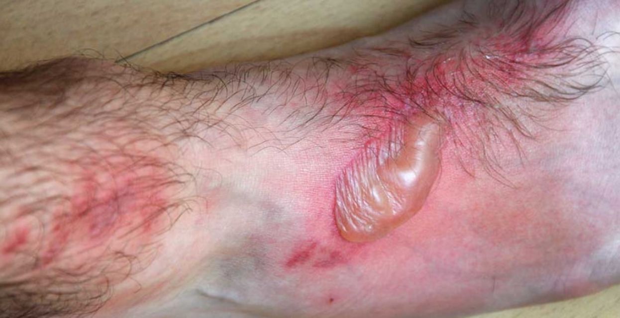 Fototoksični in fotoalergijski dermatitis