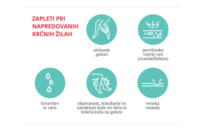 Infografika prikazuje pogoste zaplete nezdravljenih ali napredovalih krčnih žil.