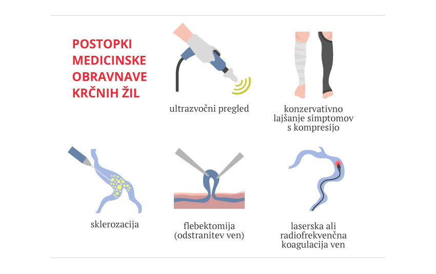 Infografika prikazuje diagnostične in terapevtske postopke zdravljenja krčnih žil.