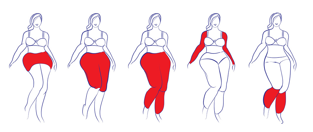 Ilustracija petih stiliziranih telesnih obrisov, ki prikazujejo pet tipov lipedema. Na vsaki figuri so z rdečo barvo označena različna območja kopičenja maščobnega in otečenega tkiva, značilnega za lipedem – od predelov bokov, stegen in meč do kombinacij, ki vključujejo tudi zgornje okončine.