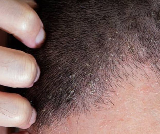 Praktični nasveti za bolnike s seboroičnim dermatitisom