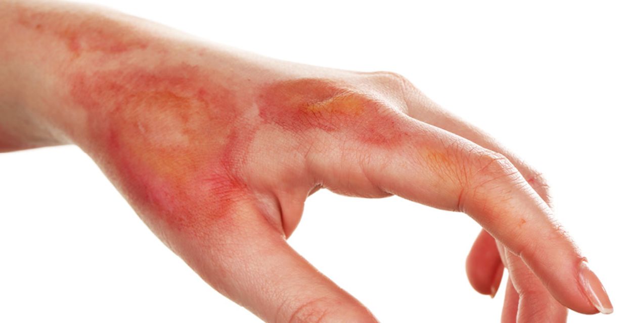 Prva pomoč &ndash; opekline