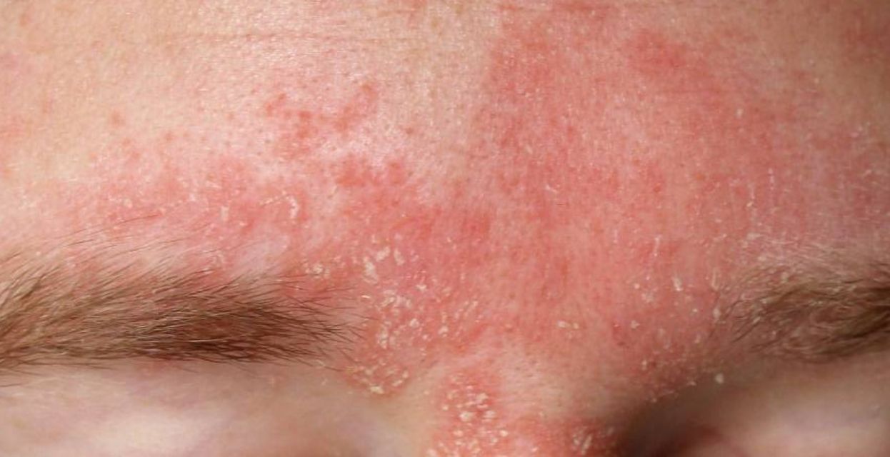 Bolezen kože &ndash; seboroični dermatitis