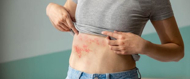Herpes zoster ‒ pasavec