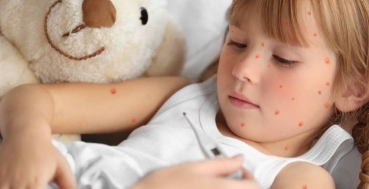 Izpu&scaron;čaji pri otroku &ndash; nalezljive bolezni