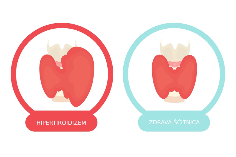 Primerjalna ilustracija dveh &scaron;čitnic: na levi povečana in poudarjeno rdeča &scaron;čitnica z oznako &lsquo;Hipertirodizem&rsquo;, na desni normalna &scaron;čitnica v mehkej&scaron;ih odtenkih rdeče z oznako &lsquo;Zdrava &scaron;čitnica&rsquo;