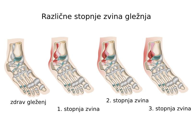 Prikaz različnih stopenj zvina gležnja, od zdravega gležnja do prve, druge in tretje stopnje zvina z različno stopnjo po&scaron;kodbe vezi.